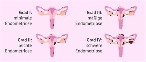 endometriose leitlinie